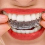 diy mail-in braces smile direct club