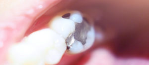 should i replace my silver fillings?